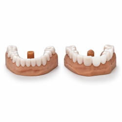 Snap On Smile, Snap on Veneers