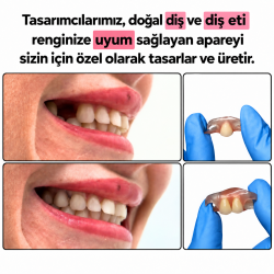 Flexible Partial Denture ROCHE Bridge
